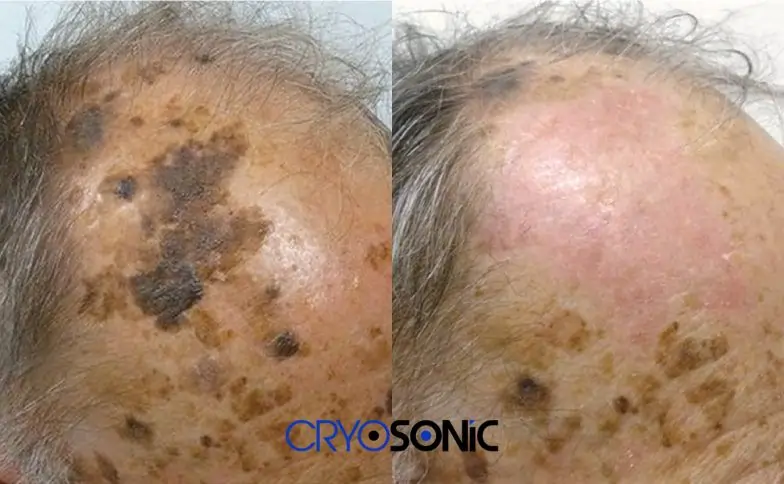 Why Do We Ignore Seborrheic Keratosis — And Then Regret It Manchester