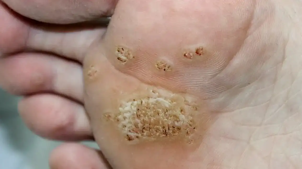Secure Your Wart Removal Appointment with One Click Manchester