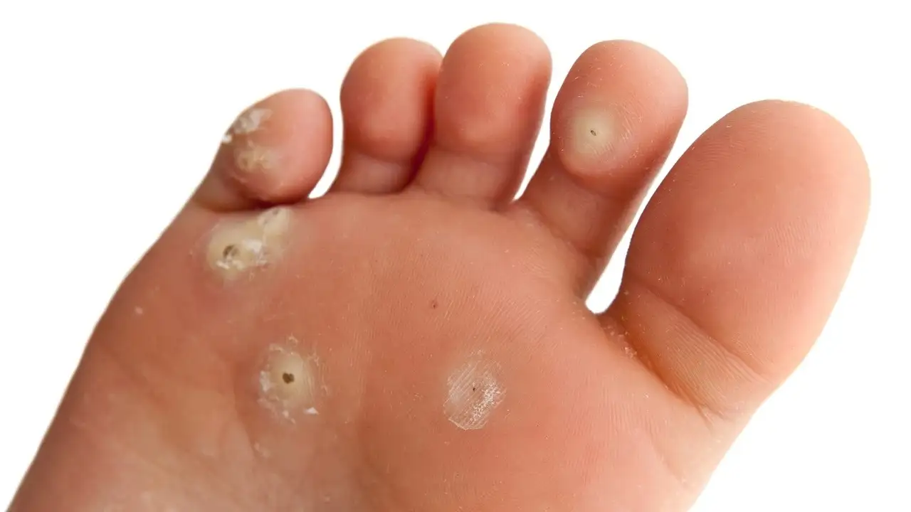 Verruca Is Painful – Top Treatments That Actually Work Manchester