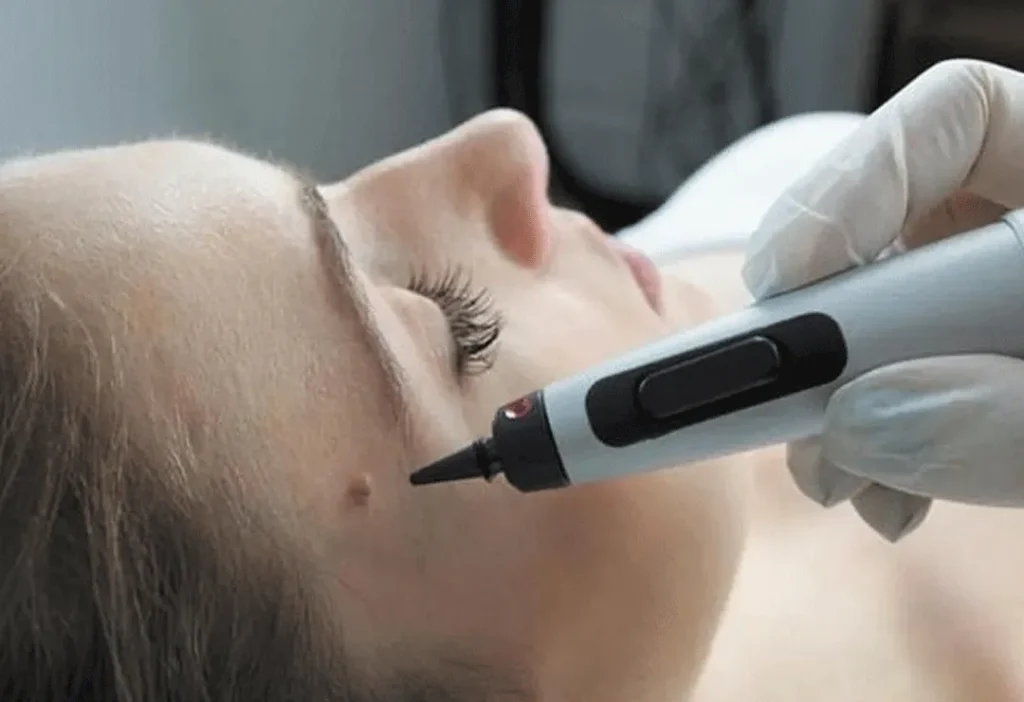 CryoPen accurately targeting skin lesions with millimetre-precision for safe and effective removal by Cryosonic Manchester