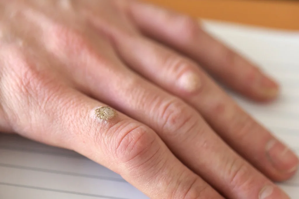 FAQs – Do Warts Return After CryoPen Treatment Manchester